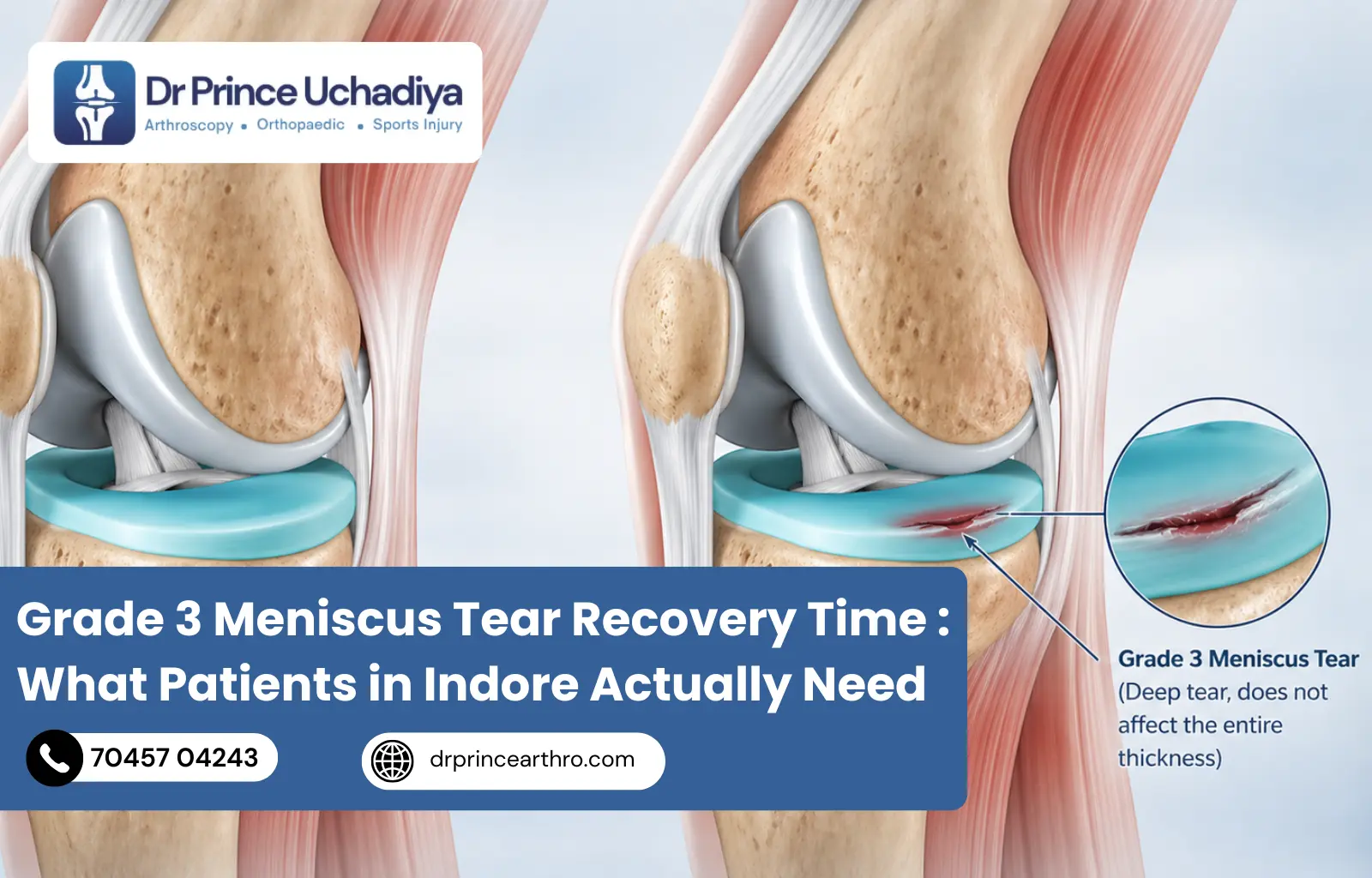 Grade 3 Meniscus Tear