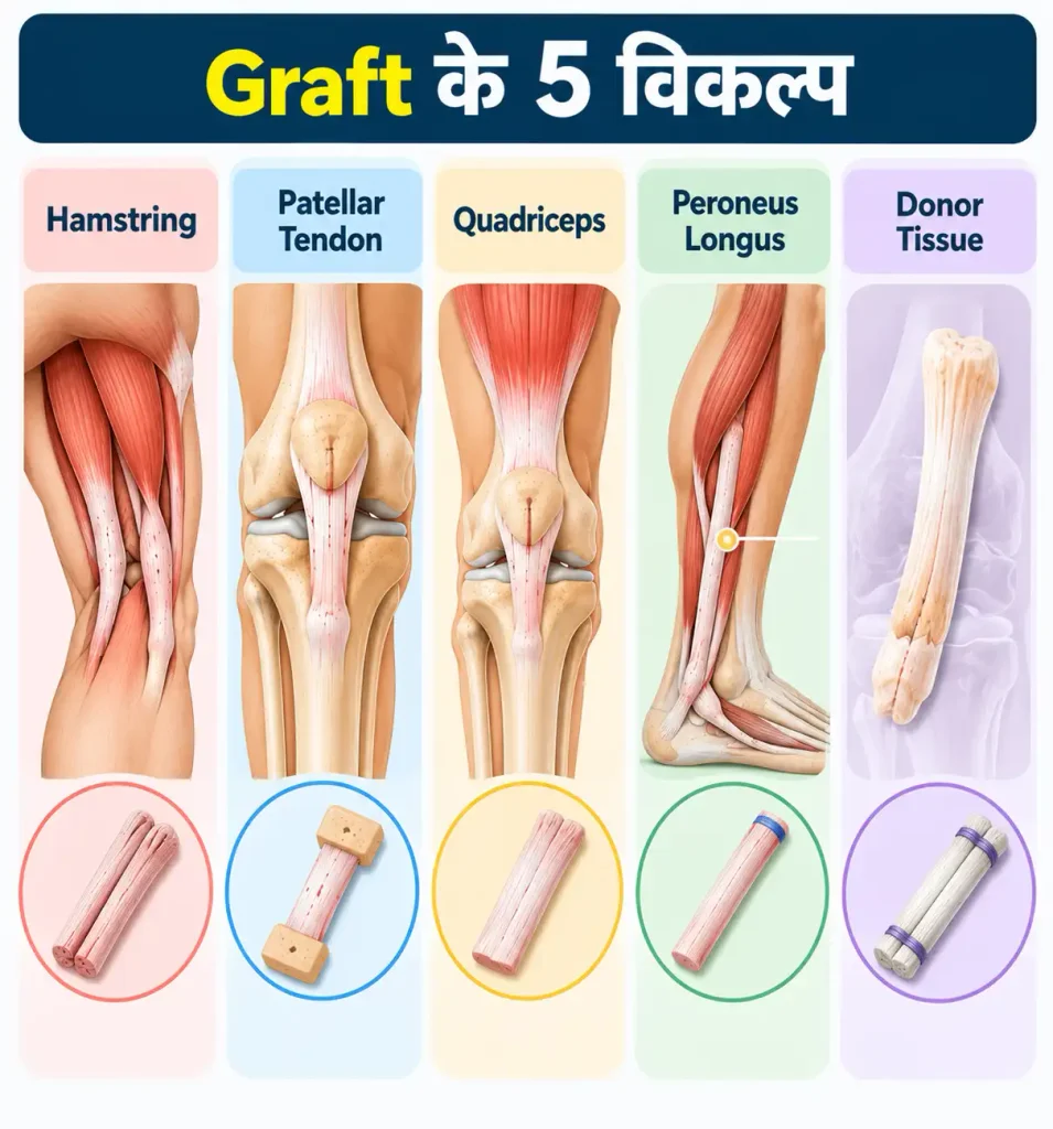 Infographic showing five ACL graft options: Hamstring, Patellar Tendon, Quadriceps, Peroneus Longus, and Donor Tissue.