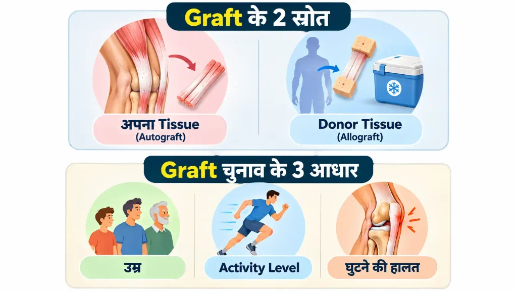Vertical infographic showing two ACL graft sources—own tissue and donor tissue—and three graft selection factors: age, activity level, and knee condition.