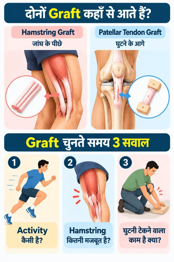Vertical infographic showing where Hamstring and Patellar Tendon Grafts come from and three questions to consider when choosing an ACL graft.